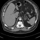 Myelolipoma of adrenal gland: CT - Computed tomography